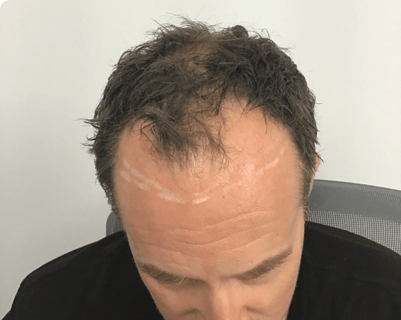 Hair Transplant Results & Before & After Photos & Video