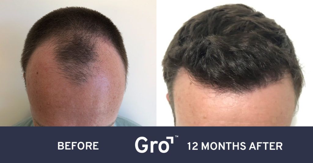 Jonathan's before and after photos 12 months post hair transplant