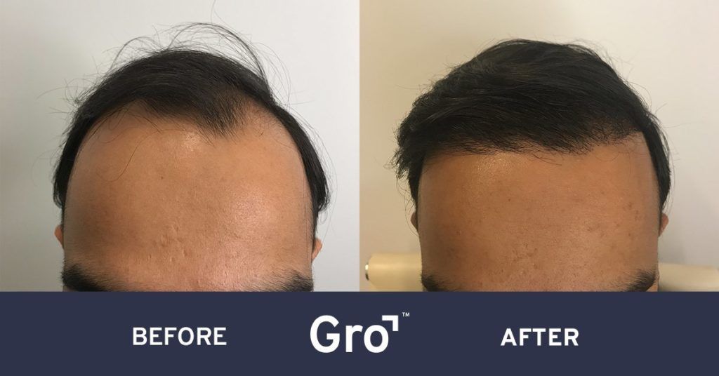 hair transplant before and after photo 12 months