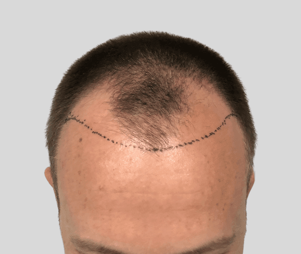 forehead reduction procedure