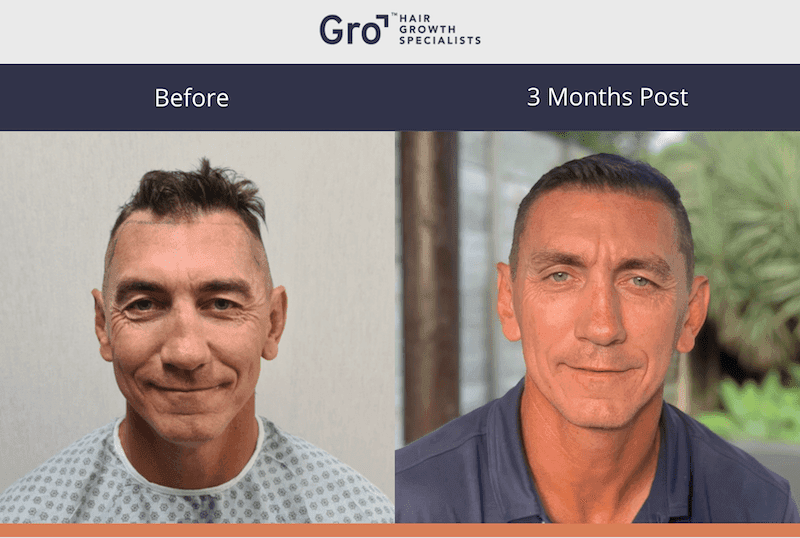 Mat Rogers hair transplant 3 months