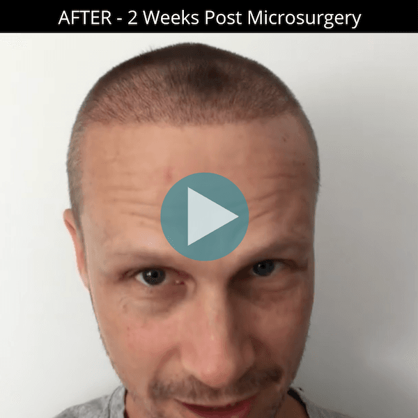 Nick 2 Wks Post hair transplant