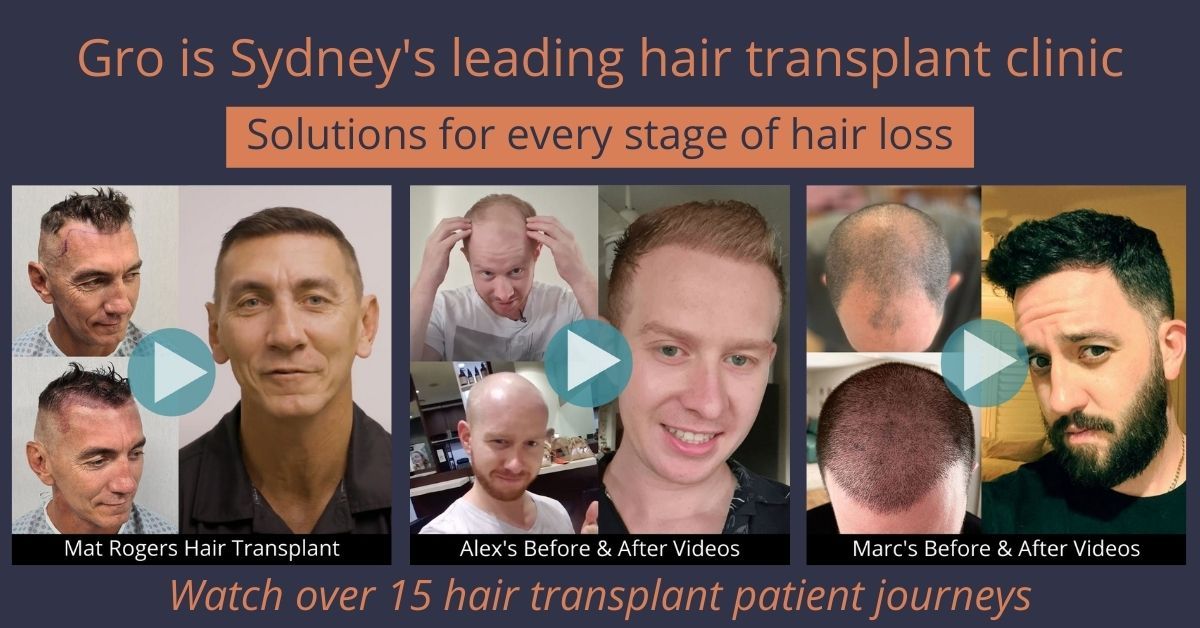 The Most Refined Hair Transplant Sydney Has Seen