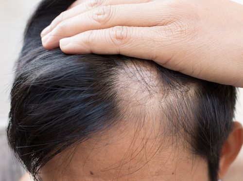 Top Tips On How To Fix Bald Spots